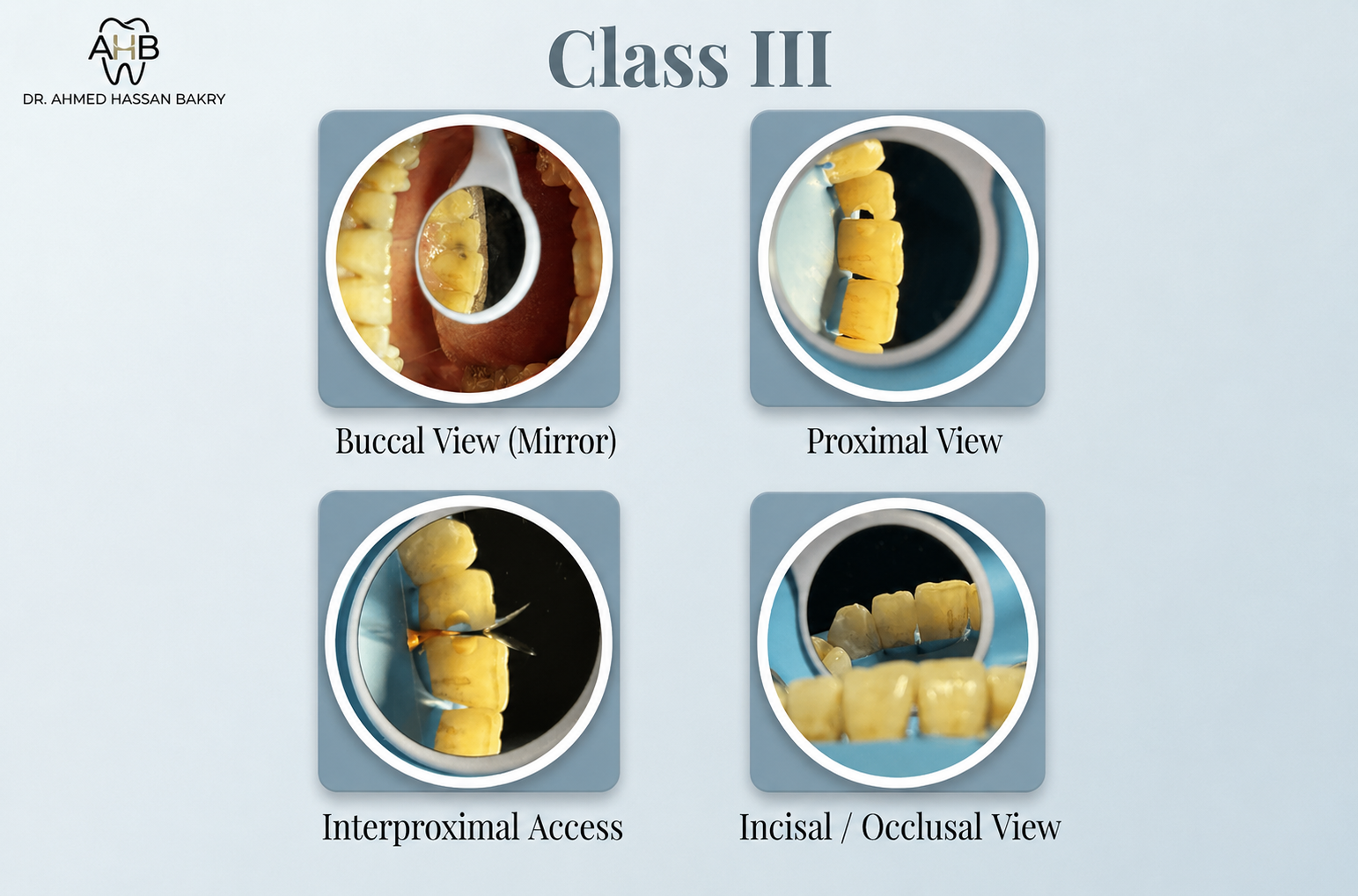 Class III